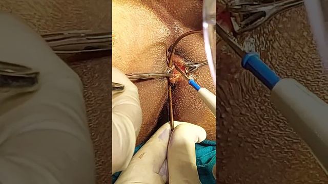 fistulectomy+Intraanal fistulotomy+ksharkarma