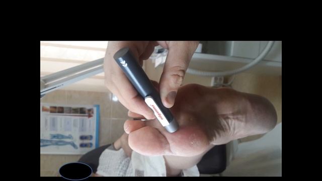 Діагностика та диференційна діагностика гнійно-некротичних уражень кінцівок при цукровому діабеті смотреть онлайн