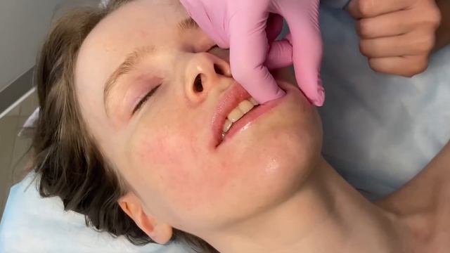 Буккальный массаж в клинике Epilux смотреть онлайн