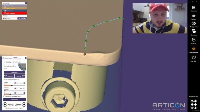 EXOCAD ARTEX TRANSFER SYSTEM. Алгоритм синхронной гипсовки