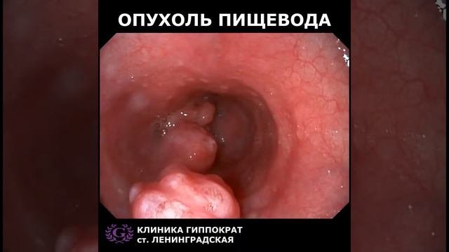 ОПУХОЛЬ ПИЩЕВОДА