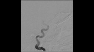 Эмболизация аневризмы ВСА