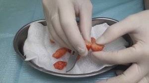 Из чего состоит липома?