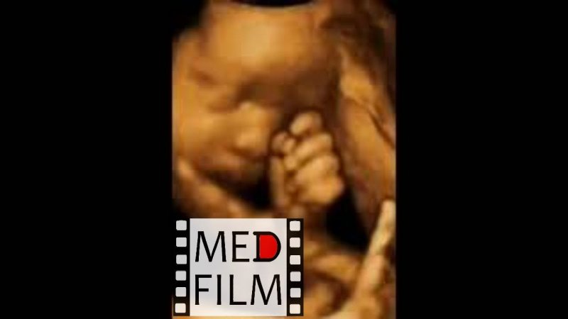 (Sh) 31 неделя беременности, 3D УЗИ © 31 weeks pregnant, 3D Ultrasound