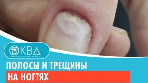 ? Полосы и трещины на ногтях. Клинический случай №583