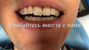 Лечение кариеса по методике Icon (Айкон) в Москве