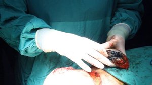 Вертикальная маммопластика и биопсия сторожевых лимфоузлов при онкозаболевании молочной железы.