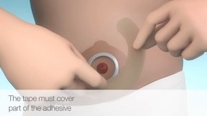 12500 Эластичная пластина полукольцо Колопласт Брава Brava Coloplast