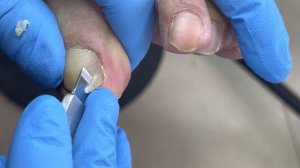 Stubborn ingrown nails, very deep, trim it vigorously【Pedicure Master Lin Jun】