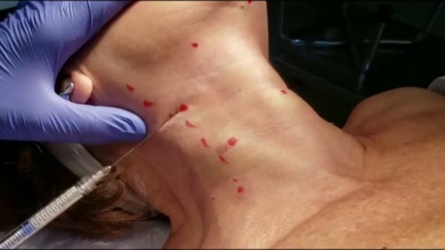 Rejuvenecimiento de cuello con Radiesse hiperdiluido y Genius (Radiofrecuencia con microagujas) смотреть онлайн