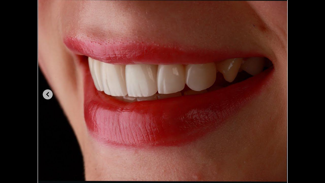 Преображение улыбки ультратонкими винирами в Orlovsky Orlovsky Dental Center Правобережье / Калуга