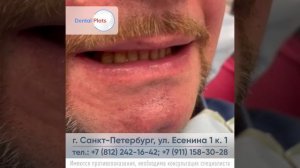 Пациент неделю назад установил у нас несъемный протез на верхнюю челюсть и сегодня ставим на нижнюю