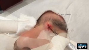 A Life-Changing Pop with Dr Pimple Popper