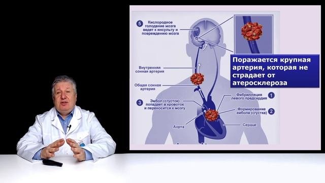 Когнита или как предотвращать инсульты и деменцию?
