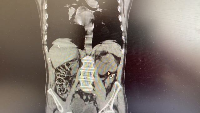 Гидронефроз КТ смотреть онлайн