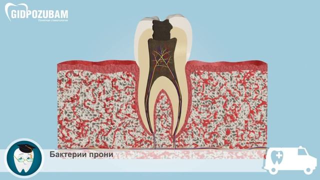 Киста и гранулема: причины образования кист и гранулем смотреть онлайн