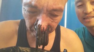 Пиявки Хиджама Саипов Мунарбек 0708105040'демодекоз'