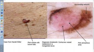 Dermoscopy Made Simple - Amelanotic melanoma