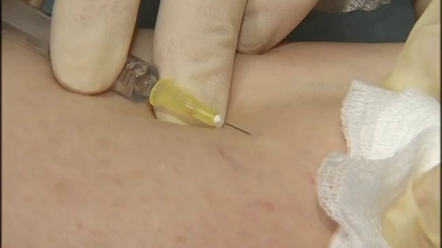 Пенная склеротерапия