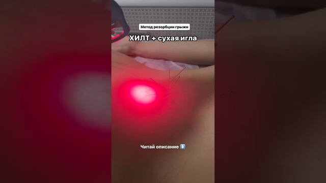 Лечение грыжи