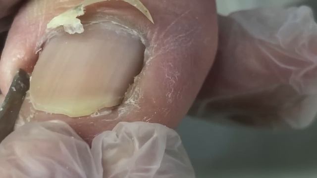 Swollen toes with ingrown toenails, professional pedicure【Crazy pedicure room】 смотреть онлайн