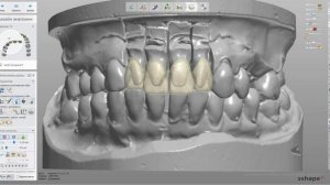 Циркониевые мост.