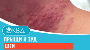? Прыщи и зуд шеи. Клинический случай №813