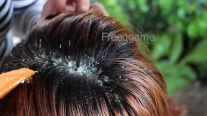 Psoriasis Huge Flakes!!! Itchy Scalp Of Dandruff Removal #196
