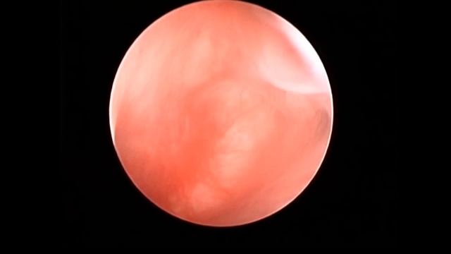 Атрезия хоаны у кота. смотреть онлайн