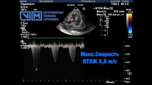 Субаортальный стеноз