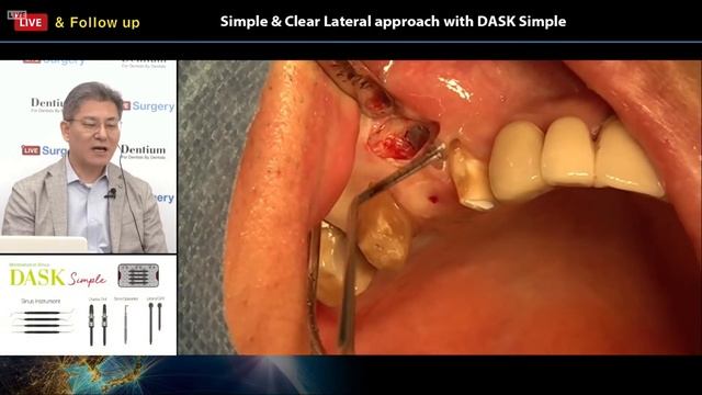 Live Surgery  Follow up Simple  Clear Lateral Approach with DASK Simple