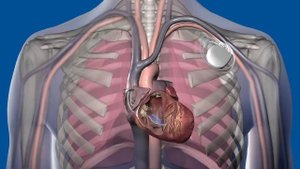 Аритмология   Medtronic Кардиостимуляторы Принцип работы Pacemaker