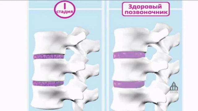 Здоровый позвоночник 4 лекция. Заболевания позвоночника