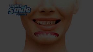 виниры perfect smile veneers инструкция