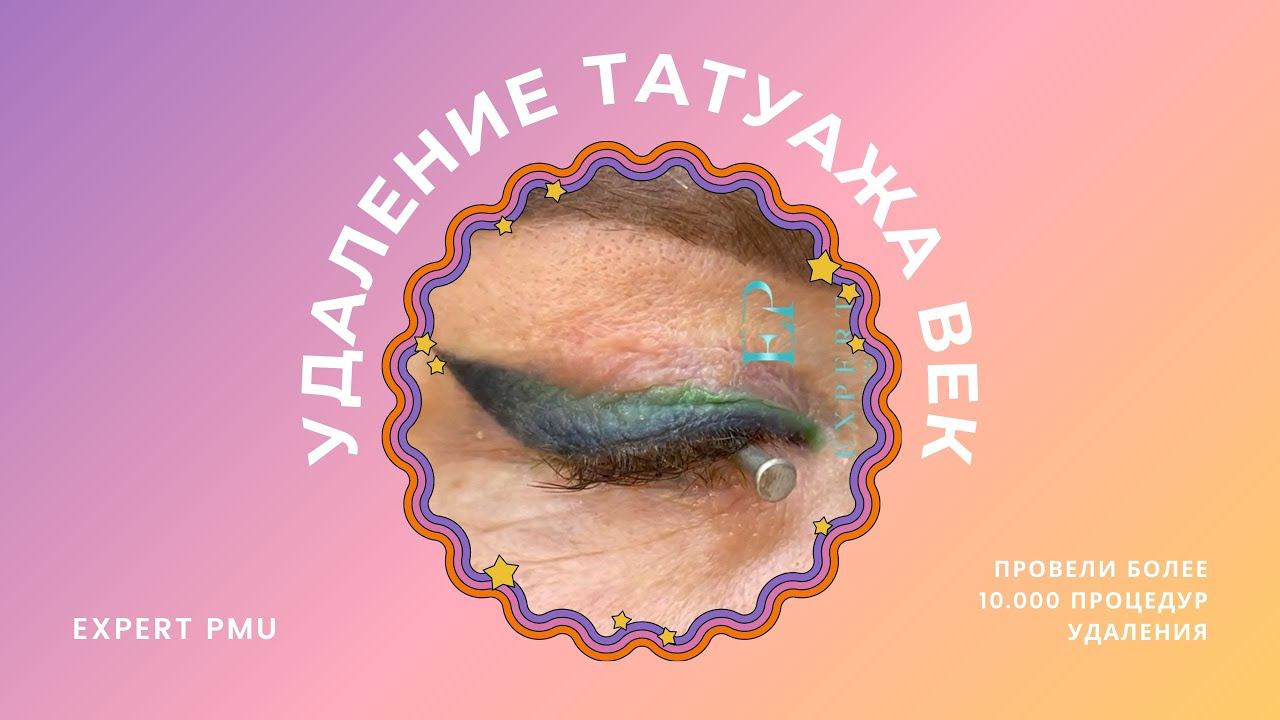 Лазерное удаление татуажа цветных стрелочек