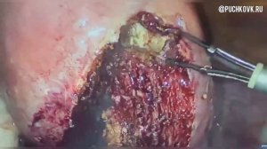 Лапароскопическая миомэктомия при крупном субмукозном узле