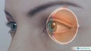 Что такое глаукома?