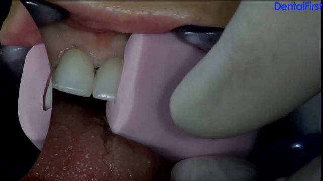 Variolink Esthetic - Решение для всех типов реставраций и материалов смотреть онлайн