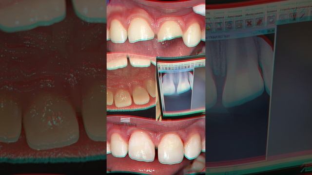 Восстановление зубов после их перелома