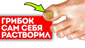 Вот с чем смешать соду, чтобы избавиться от грибка ногтей
