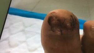 Большой палец ноги после перелома, содран ноготь.