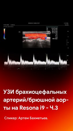 УЗИ брахиоцефальных артерий и брюшной аорты. Часть 3