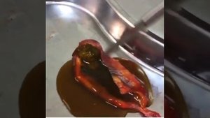 Лапароскопическое удаление желчного пузыря.(1)