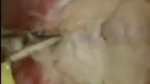 Septum Procedure performed at Pulse Womens Hosptial