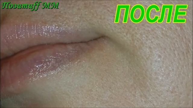 ЭТО средство от ШЕЛУШЕНИЯ и трещин на коже МГНОВЕННО лечит ЗАЕДЫ. смотреть онлайн