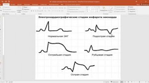 ЭКГ при инфаркте миокарда, стенокардии