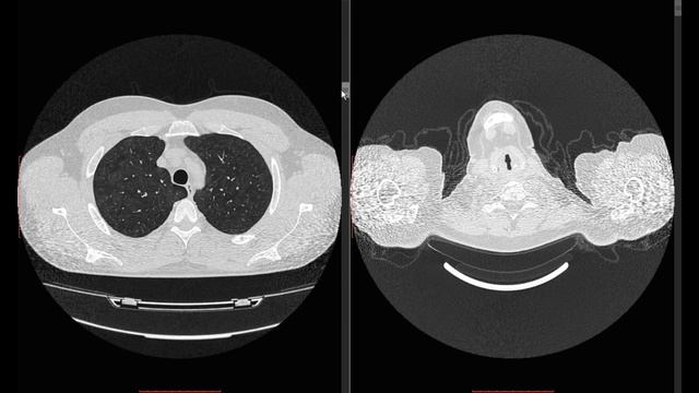 Диагностика и динамика COVID пневмоний смотреть онлайн