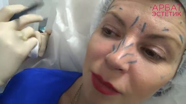 Инъекции ботулотоксинов. Заячьи морщины. смотреть онлайн