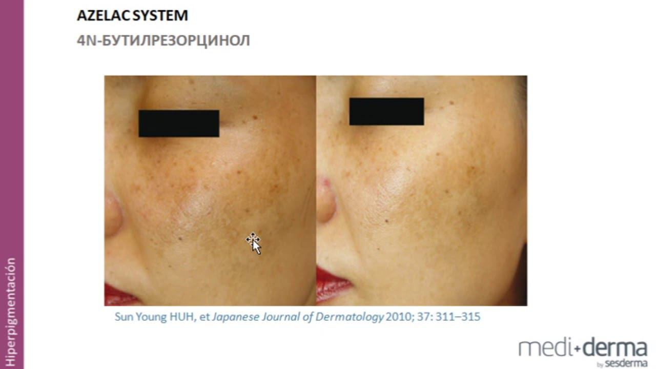 Отбеливание с Sesderma
