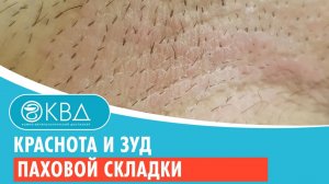 ? Краснота и зуд паховой складки. Клинический случай №933